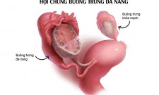 Phác đồ điều trị Hội trứng Buồng trứng đa nang – Vụ sức khỏe Bà mẹ – Trẻ em – Bộ Y tế