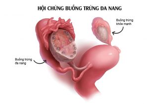 Hình ảnh buồng trứng đa nang