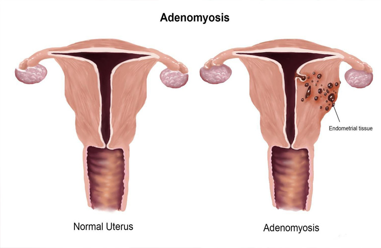 Bệnh lạc nội mạc trong cơ tử cung là gì, có đáng lo ngại?