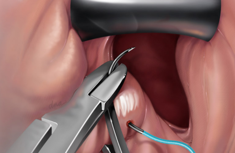 Phẫu thuật cắt bỏ tử cung có thể được chỉ định để điều trị lạc nội mạc trong cơ tử cung