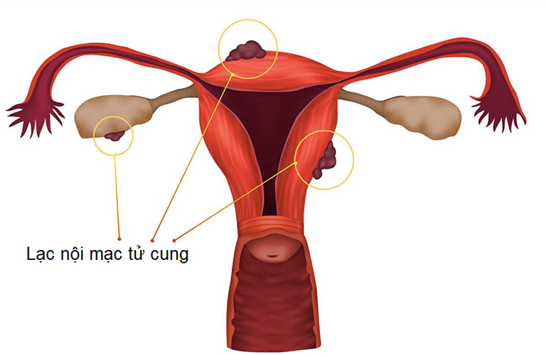 Phẫu thuật được chỉ định khi lạc nội mạc tử cung nghiêm trọng, xâm lấn tới nhiều bộ phận