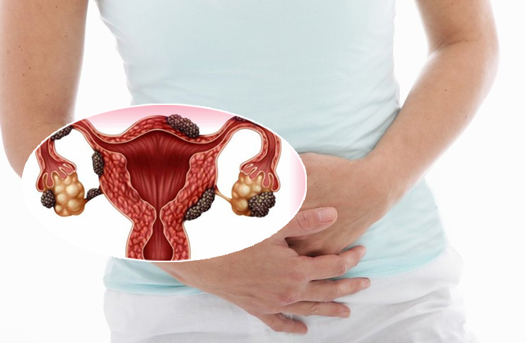 Lạc nội mạc tử cung thành bụng có đáng lo ngại hay không?