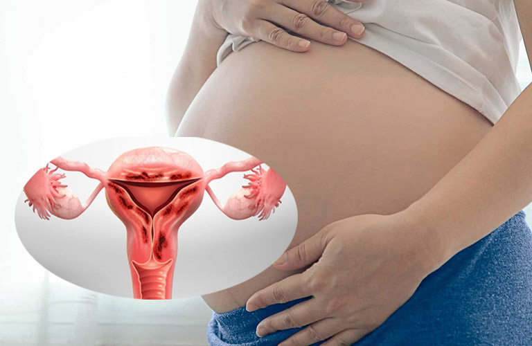 Chị em phụ nữ bị lạc nội mạc tử cung có thể mang thai không?