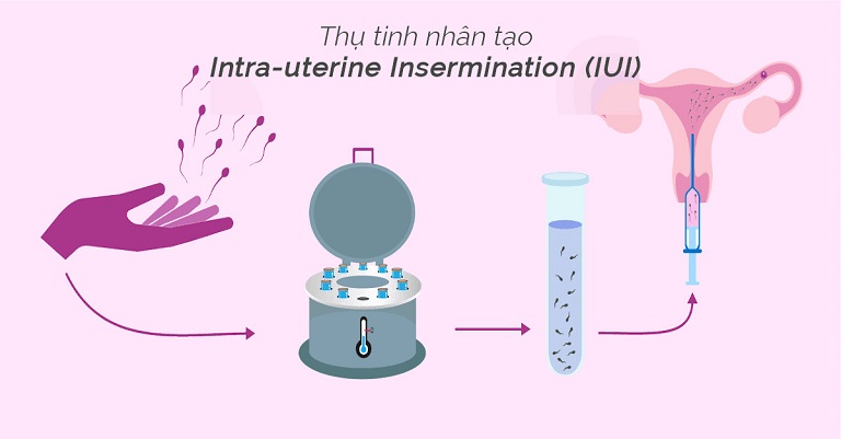 Thụ tinh nhân tạo IUI