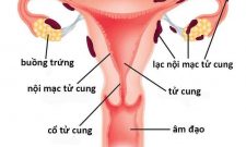 Phác đồ điều trị Lạc nội mạc tử cung của Bộ Y tế