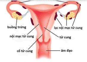 Phác đồ điều trị lạc nội mạc tử cung của Bộ Y tế