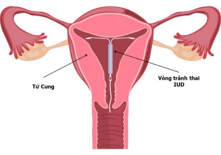 Rong kinh là tác dụng phụ thường gặp sau đặt vòng tránh thai