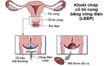 Chữa viêm lộ tuyến bằng LEEP: Những thông tin chị em cần nắm rõ