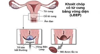 Chữa viêm lộ tuyến bằng LEEP: Những thông tin chị em cần nắm rõ