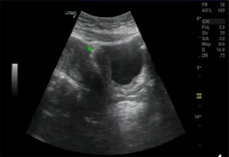 Hình ảnh lạc nội mạc tử cung trên siêu âm ở một bệnh nhân nữ