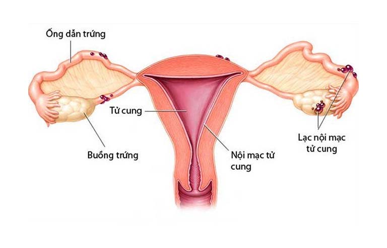 Hình ảnh lạc nội mạc tử cung buồng trứng