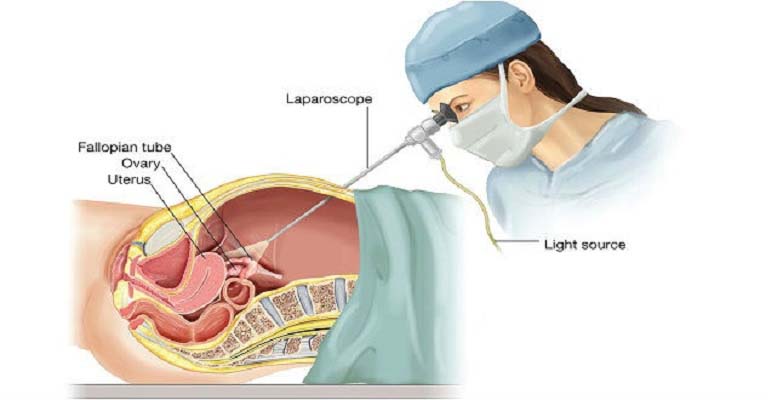 Phương pháp mổ nội soi được áp dụng cho bệnh nhân viêm phần phụ