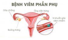 Viêm Phần Phụ Phải (Trái): Nguyên Nhân, Cách Điều Trị Hiệu Quả