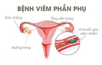 Viêm phần phụ bên phải (trái) thường xuất hiện ở phụ nữ trong độ tuổi sinh sản.
