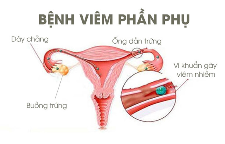 Viêm phần phụ bên phải (trái) thường xuất hiện ở phụ nữ trong độ tuổi sinh sản