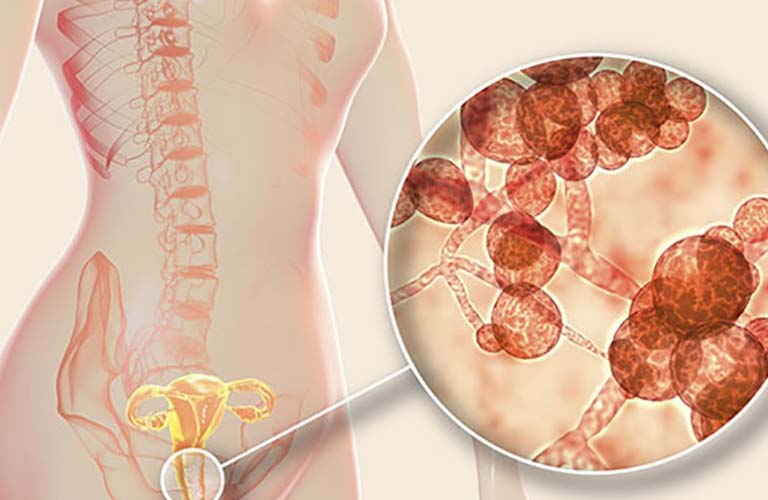 Xét nghiệm Candida là cách chẩn đoán chính xác bệnh