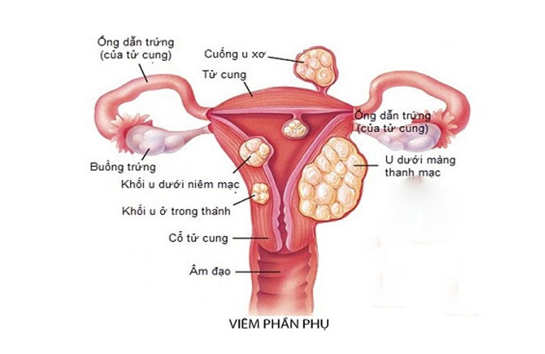 Viêm phần phụ mãn tính dai dẳng, tái phát thường xuyên khiến người bệnh mệt mỏi, khó chịu, ảnh hưởng nghiêm trọng tới sức khỏe