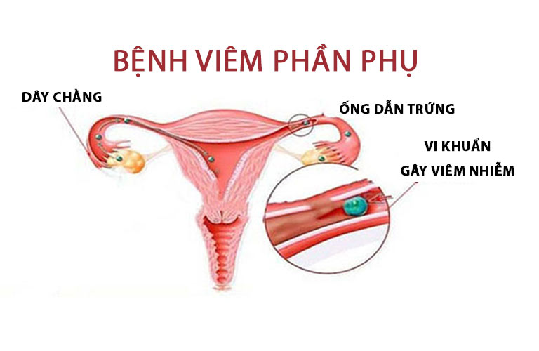 Viêm phần phụ có nguy hiểm không là thắc mắc của nhiều người