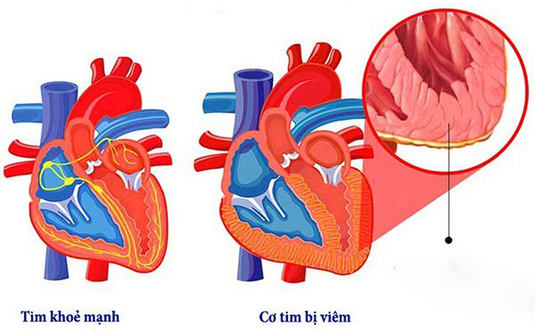 Viêm cơ tim có thể do nhiễm virus hoặc là tác dụng không mong muốn sau tiêm vaccine phòng COVID-19