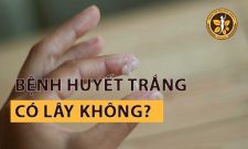 Bệnh Huyết Trắng Có Lây Không? Cần Làm Gì Khi Mắc Bệnh?