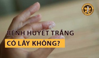 Bệnh Huyết Trắng Có Lây Không? Cần Làm Gì Khi Mắc Bệnh?