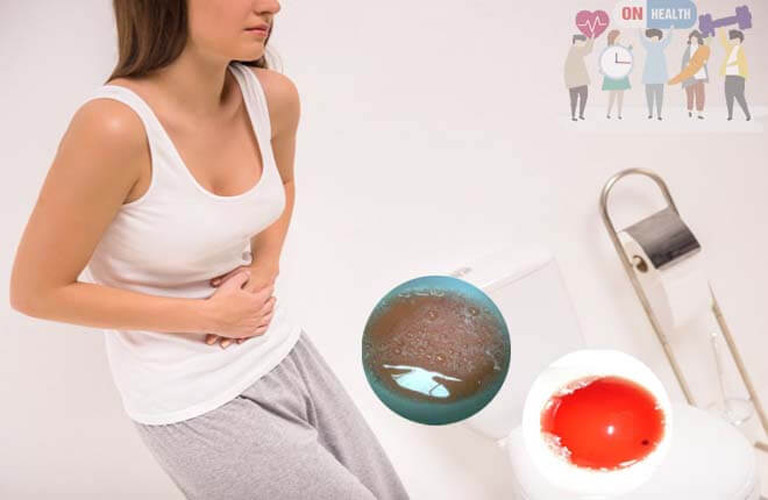 Huyết trắng màu xanh có kèm mủ hoặc máu là dấu hiệu bệnh lậu