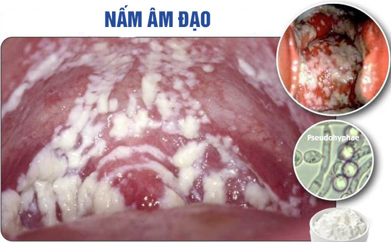 Hình ảnh viêm âm đạo do nấm Candida