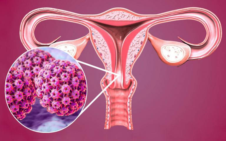 Nhiễm HPV có thể dẫn tới ung thư cổ tử cung