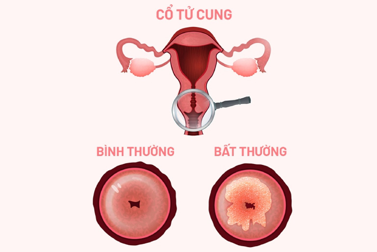 Viêm lộ tuyến cổ tử cung có nhiều cấp độ viêm nhiễm