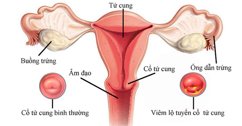 Hình ảnh bệnh viêm lộ tuyến cổ tử cung