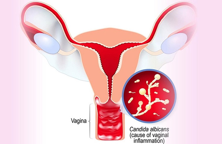 Nấm Candida là tác nhân gây viêm âm đạo phổ biến ở nữ giới