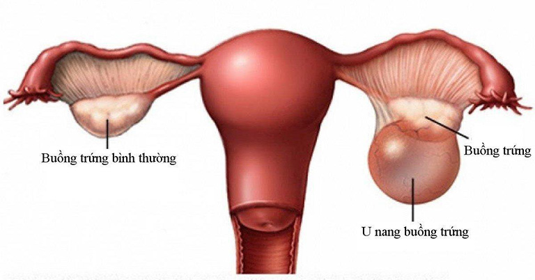 Lạc nội mạc tử cung nếu không xử lý tốt có thể dẫn đến nhiều bệnh lý phụ khoa gây hại cho sức khỏe