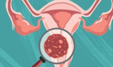 Viêm Lộ Tuyến Cổ Tử Cung Có Tự Khỏi Không? [CHUYÊN GIA GIẢI ĐÁP]